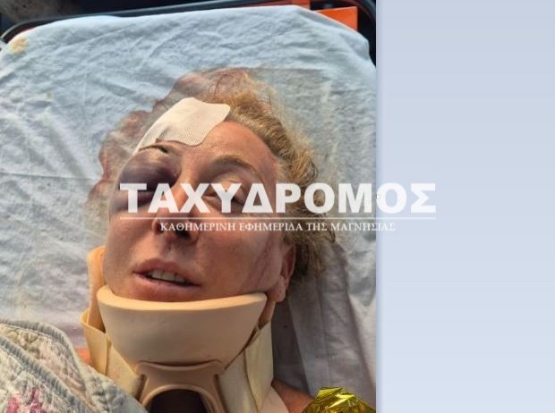 «Ετρεχαν, θα μπορούσε να πέθαινα!», λέει η Ιταλίδα λουόμενη που τραυματίστηκε από σκάφος στη Σκιάθο